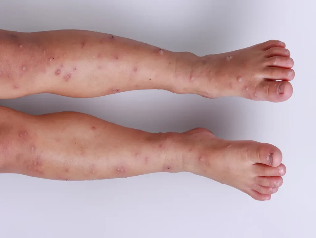 Hand Foot Mouth Virus Red Blisters on Knees