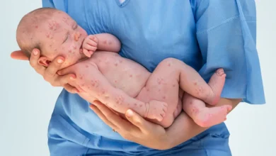 Measles 101