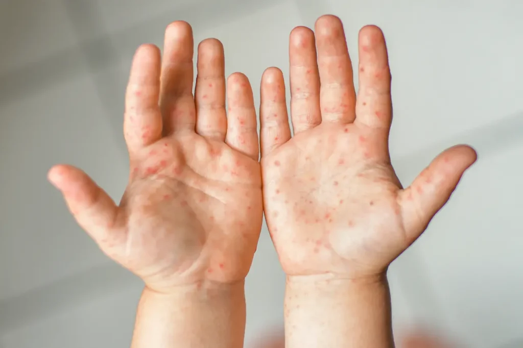 Red Blisters on Hands